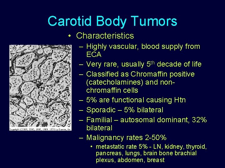 Carotid Body Tumors • Characteristics – Highly vascular, blood supply from ECA – Very