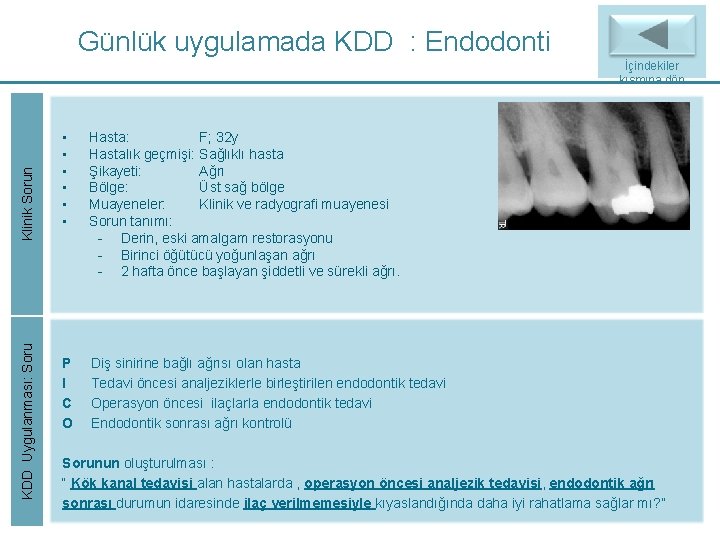 Günlük uygulamada KDD : Endodonti KDD Uygulanması: Soru Klinik Sorun İçindekiler kısmına dön • Günlük uygulamada KDD : Endodonti KDD Uygulanması: Soru Klinik Sorun İçindekiler kısmına dön •