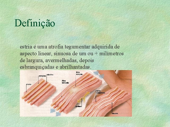 Definição estria é uma atrofia tegumentar adquirida de aspecto linear, sinuosa de um ou