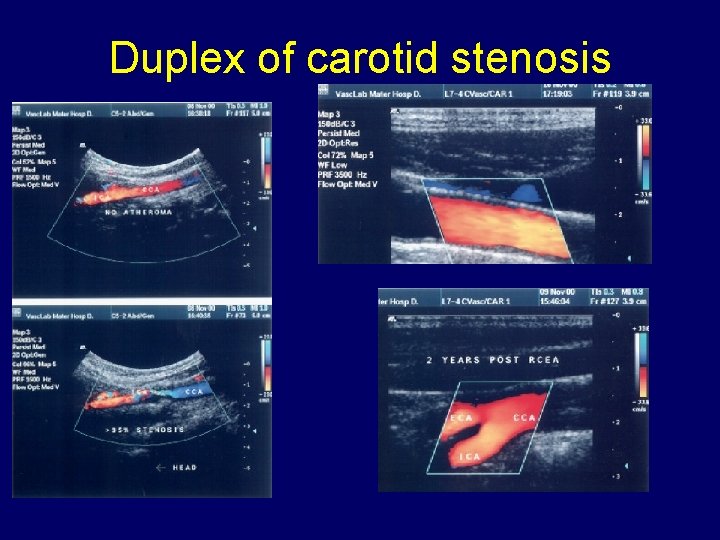 Duplex of carotid stenosis 