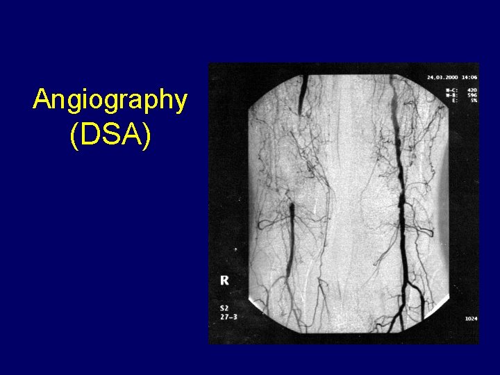 Angiography (DSA) 