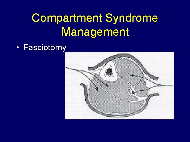 Compartment Syndrome Management • Fasciotomy 