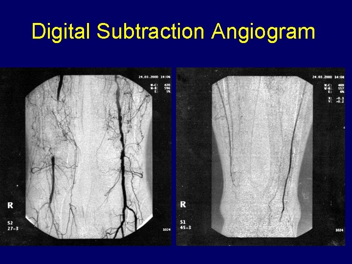 Digital Subtraction Angiogram 