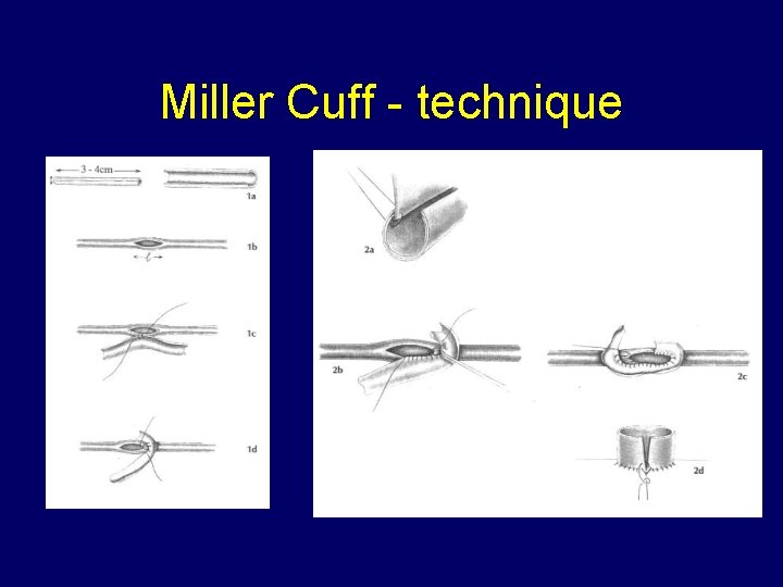 Miller Cuff - technique 