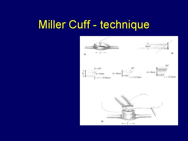 Miller Cuff - technique 