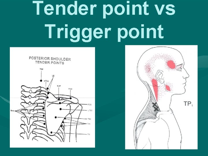 Tender point vs Trigger point 