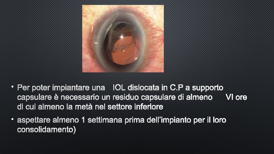  • PER POTER IMPIANTARE UNA IOL DISLOCATA INC. P A SUPPORTO CAPSULARE È