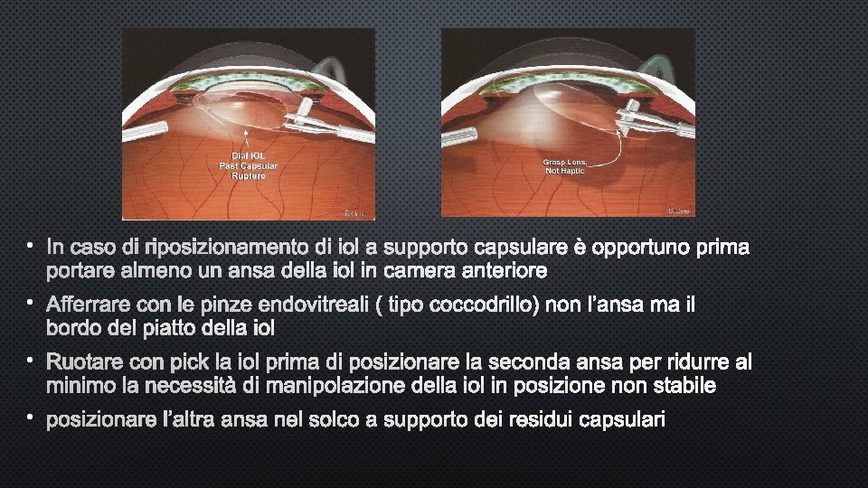  • IN CASO DI RIPOSIZIONAMENTO DI IOL A SUPPORTO CAPSULARE È OPPORTUNO PRIMA