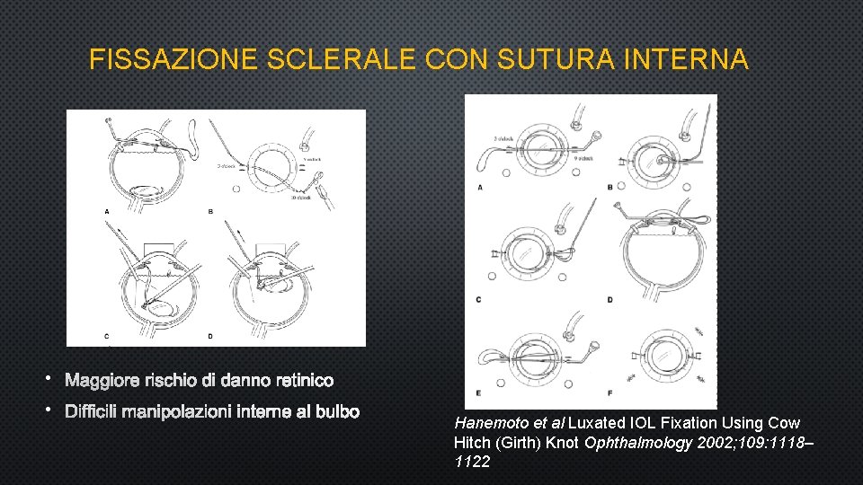 FISSAZIONE SCLERALE CON SUTURA INTERNA • MAGGIORE RISCHIO DI DANNO RETINICO • DIFFICILI MANIPOLAZIONI