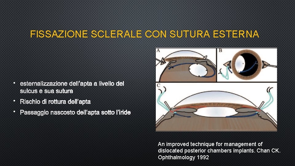 FISSAZIONE SCLERALE CON SUTURA ESTERNA • ESTERNALIZZAZIONE DELL’APTA A LIVELLO DEL SULCUS E SUA