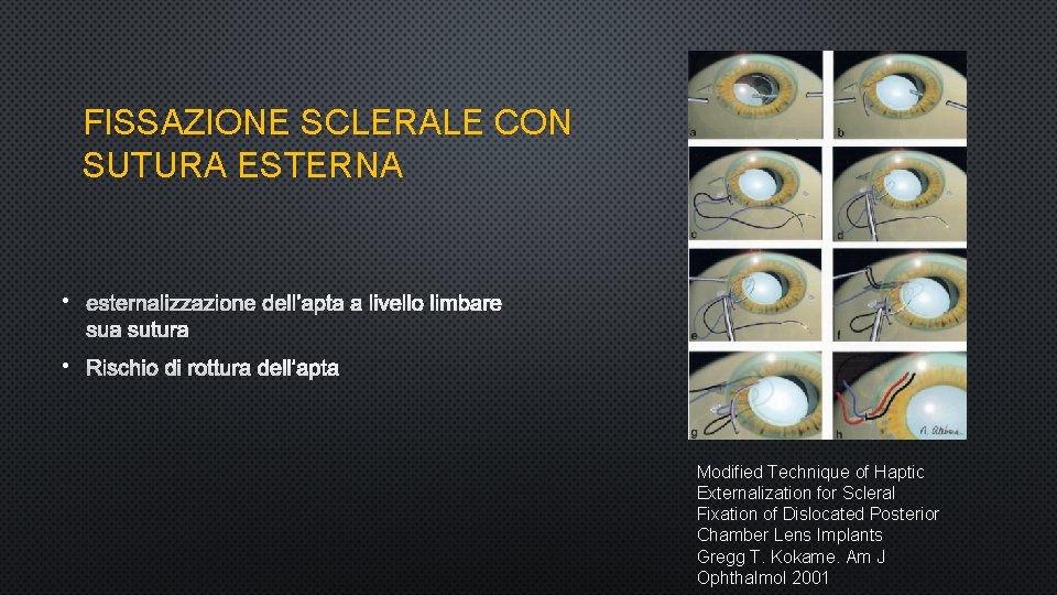 FISSAZIONE SCLERALE CON SUTURA ESTERNA • ESTERNALIZZAZIONE DELL’APTA A LIVELLO LIMBARE SUA SUTURA •