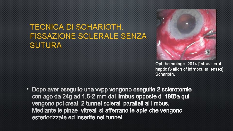 TECNICA DI SCHARIOTH. FISSAZIONE SCLERALE SENZA SUTURA Ophthalmologe. 2014 [Intrascleral haptic fixation of intraocular
