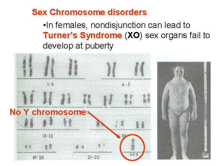 Sex Chromosome disorders • In females, nondisjunction can lead to Turner’s Syndrome (XO) sex