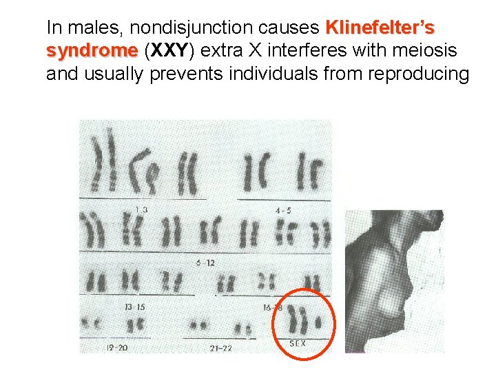 In males, nondisjunction causes Klinefelter’s syndrome (XXY) extra X interferes with meiosis syndrome and