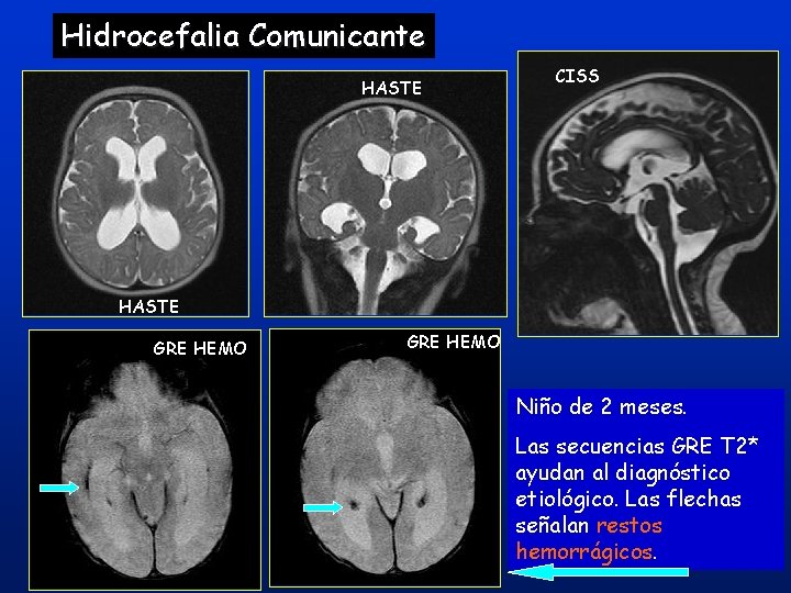 Hidrocefalia Comunicante HASTE CISS HASTE GRE HEMO Niño de 2 meses. Las secuencias GRE Hidrocefalia Comunicante HASTE CISS HASTE GRE HEMO Niño de 2 meses. Las secuencias GRE