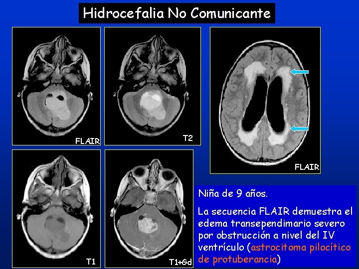 Hidrocefalia No Comunicante FLAIR T 2 FLAIR Niña de 9 años. T 1+Gd La Hidrocefalia No Comunicante FLAIR T 2 FLAIR Niña de 9 años. T 1+Gd La