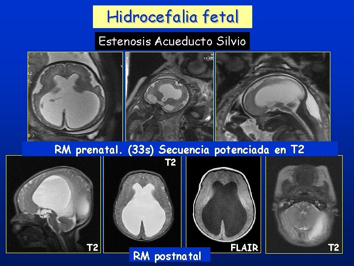 Hidrocefalia fetal Estenosis Acueducto Silvio RM prenatal. (33 s) Secuencia potenciada en T 2 Hidrocefalia fetal Estenosis Acueducto Silvio RM prenatal. (33 s) Secuencia potenciada en T 2