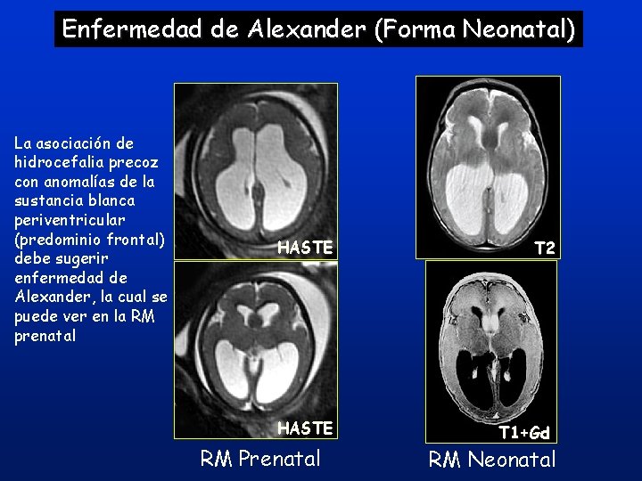 Enfermedad de Alexander (Forma Neonatal) La asociación de hidrocefalia precoz con anomalías de la Enfermedad de Alexander (Forma Neonatal) La asociación de hidrocefalia precoz con anomalías de la