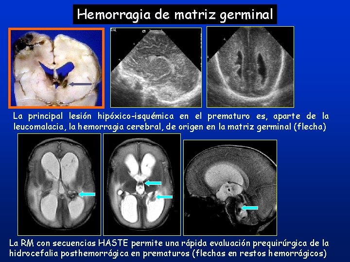 Hemorragia de matriz germinal La principal lesión hipóxico-isquémica en el prematuro es, aparte de Hemorragia de matriz germinal La principal lesión hipóxico-isquémica en el prematuro es, aparte de