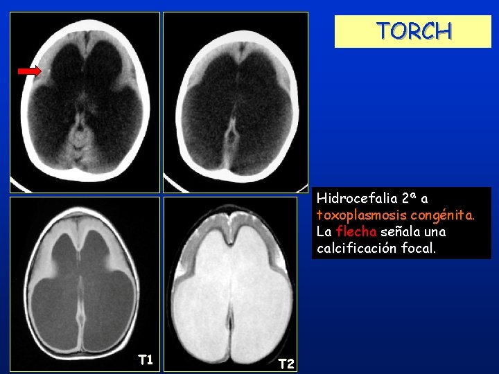 TORCH Hidrocefalia 2ª a toxoplasmosis congénita. La flecha señala una calcificación focal. T 1 TORCH Hidrocefalia 2ª a toxoplasmosis congénita. La flecha señala una calcificación focal. T 1