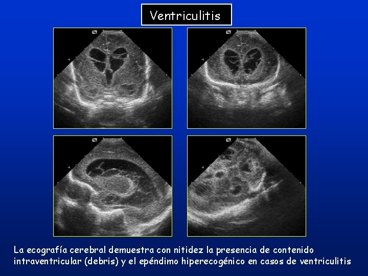 Ventriculitis La ecografía cerebral demuestra con nitidez la presencia de contenido intraventricular (debris) y Ventriculitis La ecografía cerebral demuestra con nitidez la presencia de contenido intraventricular (debris) y