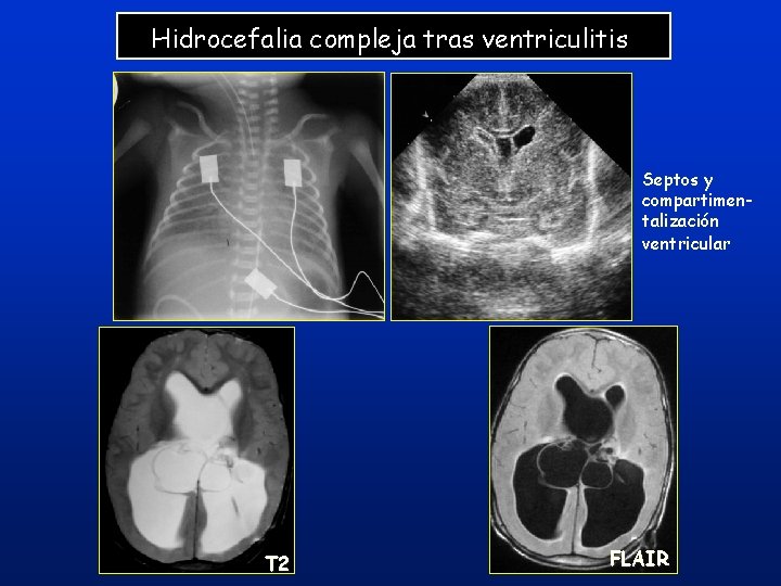 Hidrocefalia compleja tras ventriculitis Septos y compartimentalización ventricular T 2 FLAIR Hidrocefalia compleja tras ventriculitis Septos y compartimentalización ventricular T 2 FLAIR