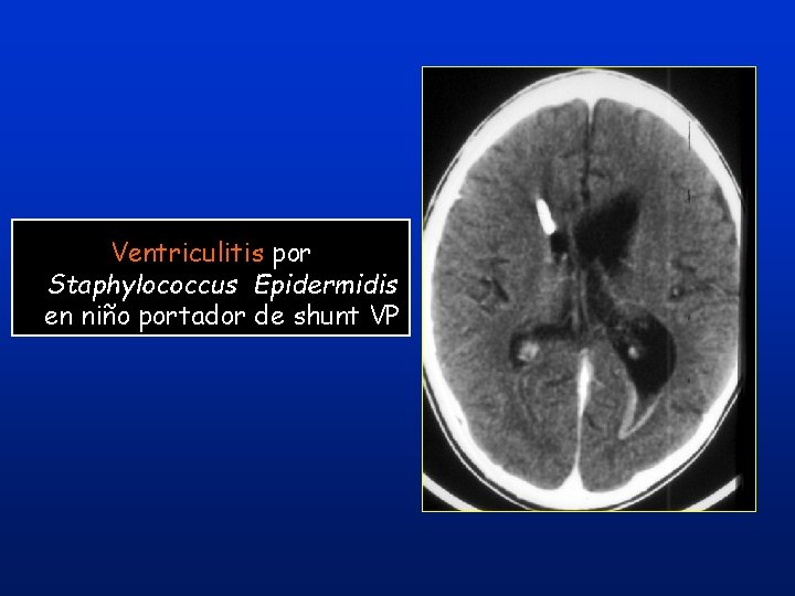 Ventriculitis por Staphylococcus Epidermidis en niño portador de shunt VP Ventriculitis por Staphylococcus Epidermidis en niño portador de shunt VP
