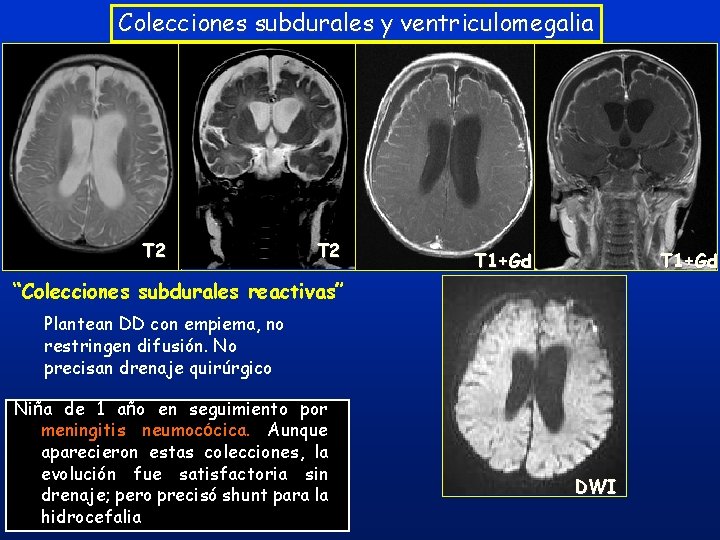 Colecciones subdurales y ventriculomegalia T 2 T 1+Gd “Colecciones subdurales reactivas” Plantean DD con Colecciones subdurales y ventriculomegalia T 2 T 1+Gd “Colecciones subdurales reactivas” Plantean DD con