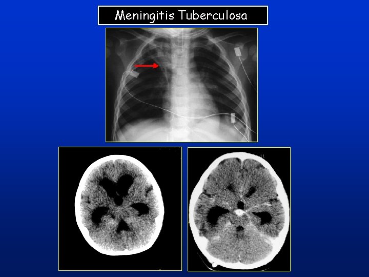 Meningitis Tuberculosa Meningitis Tuberculosa