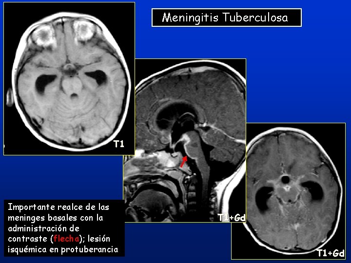 Meningitis Tuberculosa T 1 Importante realce de las meninges basales con la administración de Meningitis Tuberculosa T 1 Importante realce de las meninges basales con la administración de