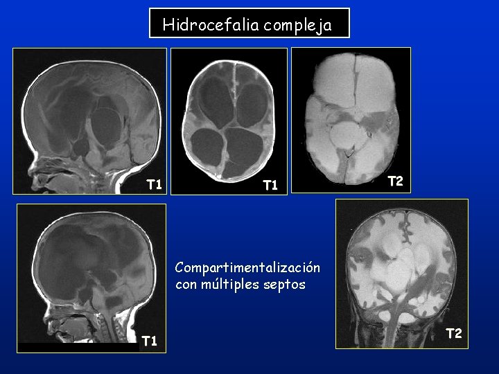 Hidrocefalia compleja T 1 T 2 Compartimentalización con múltiples septos T 1 T 2 Hidrocefalia compleja T 1 T 2 Compartimentalización con múltiples septos T 1 T 2