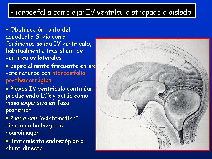 Hidrocefalia compleja: IV ventrículo atrapado o aislado § Obstrucción tanto del acueducto Silvio como Hidrocefalia compleja: IV ventrículo atrapado o aislado § Obstrucción tanto del acueducto Silvio como
