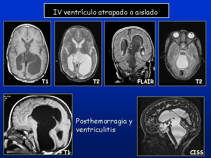 IV ventrículo atrapado o aislado T 1 T 2 FLAIR T 2 Posthemorragia y IV ventrículo atrapado o aislado T 1 T 2 FLAIR T 2 Posthemorragia y