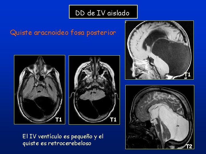 DD de IV aislado Quiste aracnoideo fosa posterior T 1 El IV ventículo es DD de IV aislado Quiste aracnoideo fosa posterior T 1 El IV ventículo es