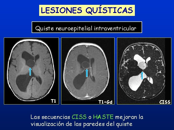 LESIONES QUÍSTICAS Quiste neuroepitelial intraventricular T 1+Gd Las secuencias CISS o HASTE mejoran la LESIONES QUÍSTICAS Quiste neuroepitelial intraventricular T 1+Gd Las secuencias CISS o HASTE mejoran la