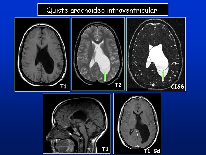 Quiste aracnoideo intraventricular T 2 T 1 CISS T 1+Gd Quiste aracnoideo intraventricular T 2 T 1 CISS T 1+Gd