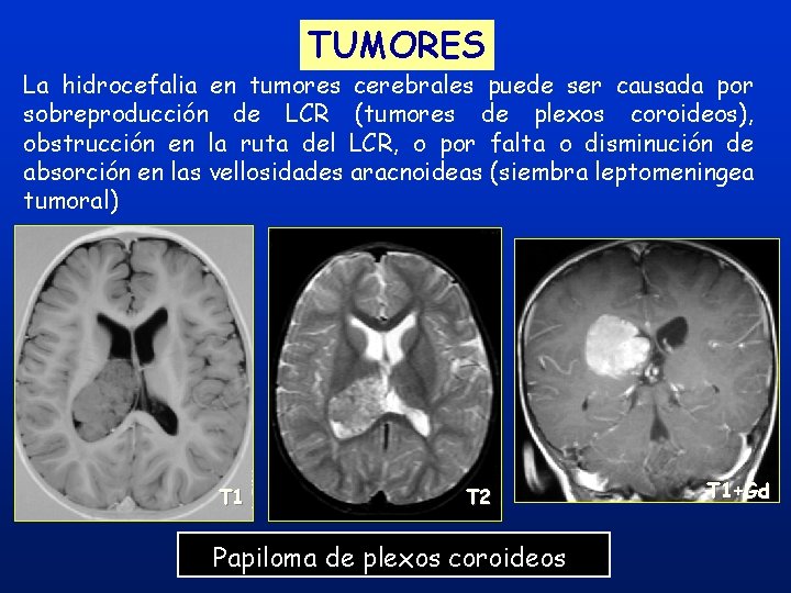 TUMORES La hidrocefalia en tumores cerebrales puede ser causada por sobreproducción de LCR (tumores TUMORES La hidrocefalia en tumores cerebrales puede ser causada por sobreproducción de LCR (tumores