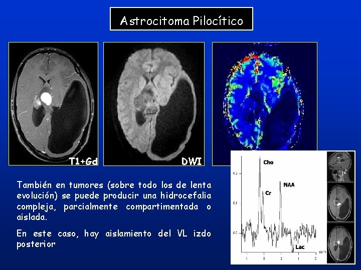 Astrocitoma Pilocítico T 1+Gd DWI También en tumores (sobre todo los de lenta evolución) Astrocitoma Pilocítico T 1+Gd DWI También en tumores (sobre todo los de lenta evolución)