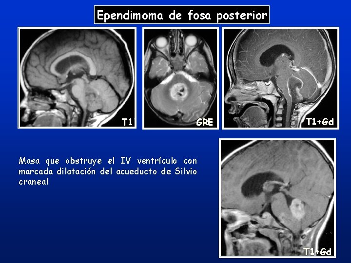 Ependimoma de fosa posterior T 1 GRE T 1+Gd Masa que obstruye el IV Ependimoma de fosa posterior T 1 GRE T 1+Gd Masa que obstruye el IV