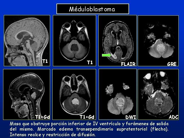 Méduloblastoma T 1 FLAIR GRE T 1+Gd ADC DWI Masa que obstruye porción inferior Méduloblastoma T 1 FLAIR GRE T 1+Gd ADC DWI Masa que obstruye porción inferior