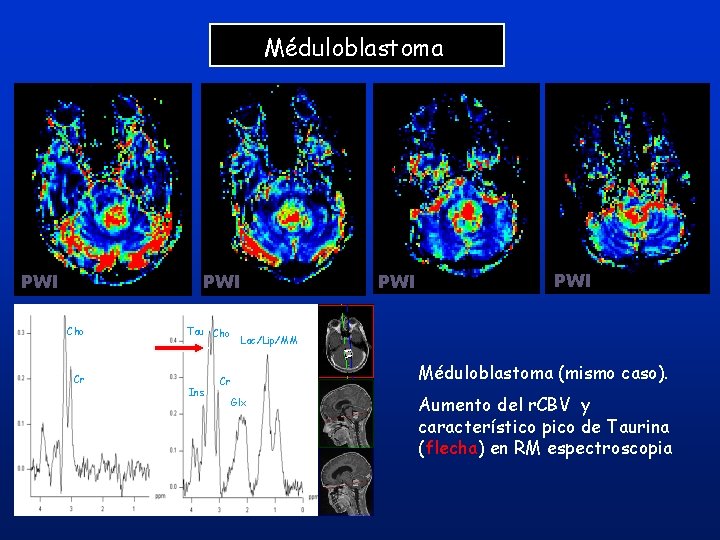 Méduloblastoma PWI Cho Tau Cho Cr Cr Ins PWI Lac/Lip/MM Méduloblastoma (mismo caso). Glx Méduloblastoma PWI Cho Tau Cho Cr Cr Ins PWI Lac/Lip/MM Méduloblastoma (mismo caso). Glx