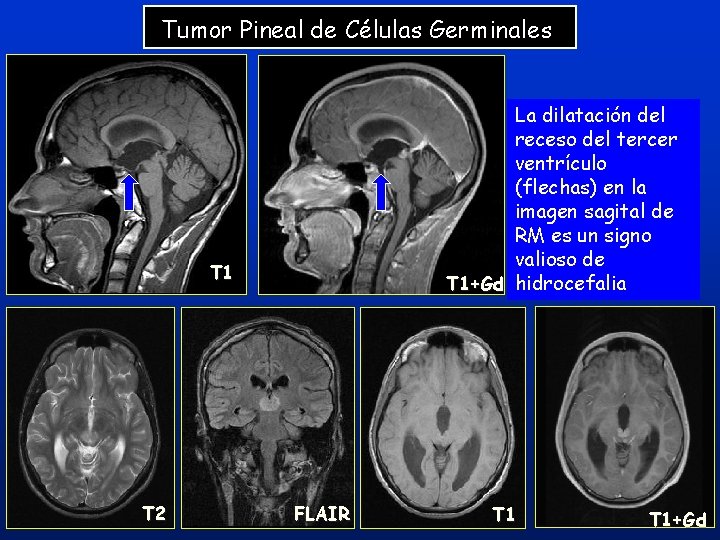 Tumor Pineal de Células Germinales La dilatación del receso del tercer ventrículo (flechas) en Tumor Pineal de Células Germinales La dilatación del receso del tercer ventrículo (flechas) en