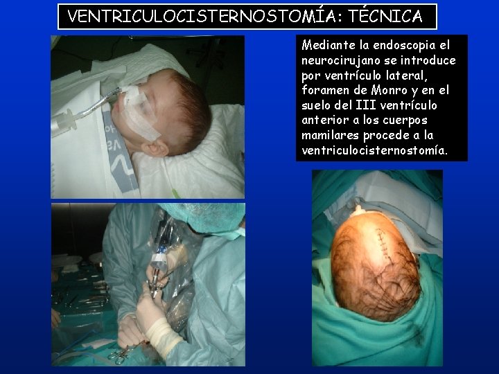 VENTRICULOCISTERNOSTOMÍA: TÉCNICA Mediante la endoscopia el neurocirujano se introduce por ventrículo lateral, foramen de VENTRICULOCISTERNOSTOMÍA: TÉCNICA Mediante la endoscopia el neurocirujano se introduce por ventrículo lateral, foramen de