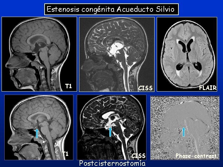 Estenosis congénita Acueducto Silvio T 1 CISS Postcisternostomía FLAIR 41 Phase-contrast Estenosis congénita Acueducto Silvio T 1 CISS Postcisternostomía FLAIR 41 Phase-contrast