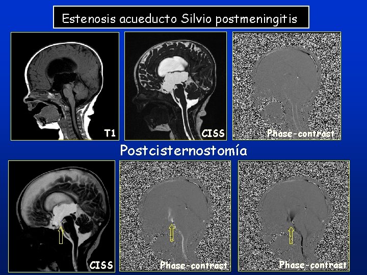 Estenosis acueducto Silvio postmeningitis T 1 CISS Postcisternostomía Phase-contrast 42 Phase-contrast Estenosis acueducto Silvio postmeningitis T 1 CISS Postcisternostomía Phase-contrast 42 Phase-contrast