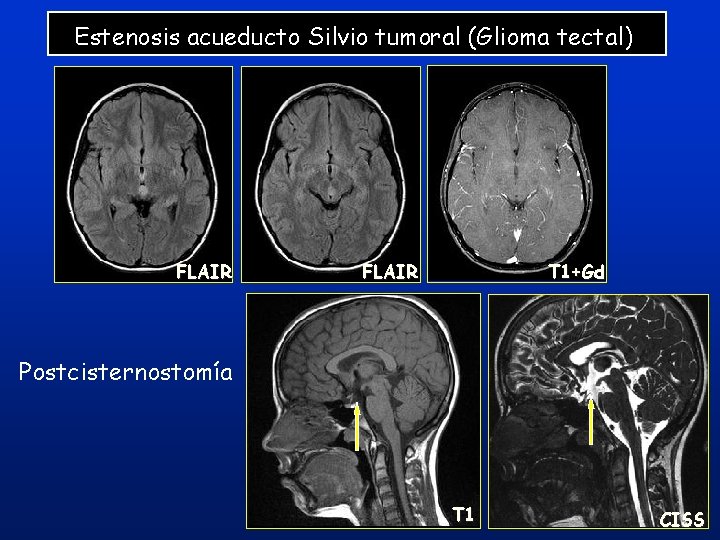 Estenosis acueducto Silvio tumoral (Glioma tectal) FLAIR T 1+Gd Postcisternostomía T 1 43 CISS Estenosis acueducto Silvio tumoral (Glioma tectal) FLAIR T 1+Gd Postcisternostomía T 1 43 CISS