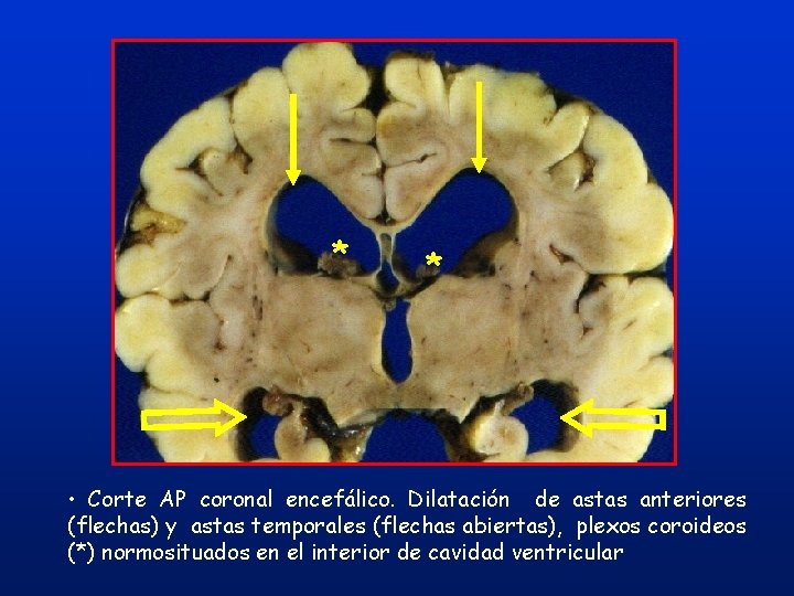 * * • Corte AP coronal encefálico. Dilatación de astas anteriores (flechas) y astas * * • Corte AP coronal encefálico. Dilatación de astas anteriores (flechas) y astas