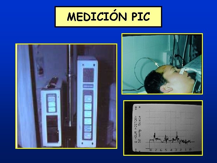 MEDICIÓN PIC MEDICIÓN PIC