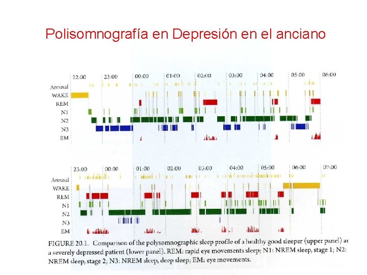 Polisomnografía en Depresión en el anciano 