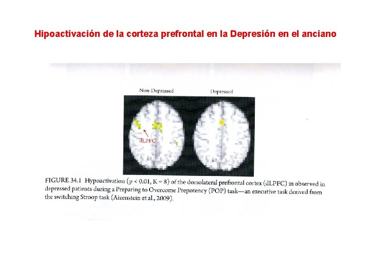 Hipoactivación de la corteza prefrontal en la Depresión en el anciano 